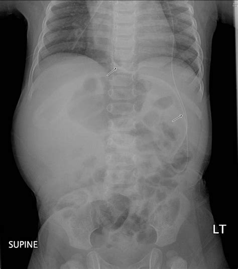 Abdominal X-ray showing ventriculoperitoneal shunt tip perforating the ...