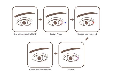 Monolid Eyes: Epicanthal Folds Causes | atelier-yuwa.ciao.jp