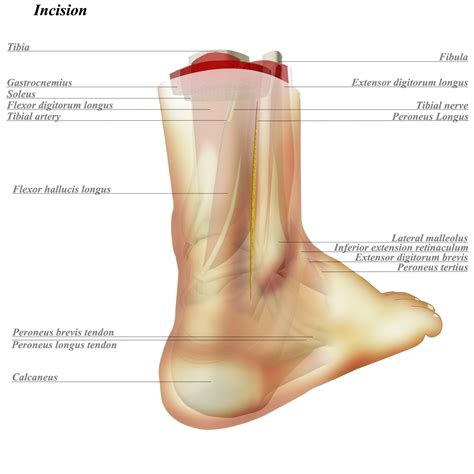 Ankle Posterolateral Approach - Approaches - Orthobullets