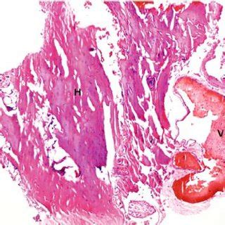 Fatty filum terminale ( arrow ) in the patient with lumbar disc disease... | Download Scientific ...