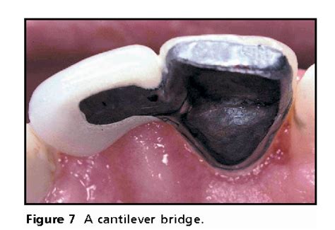 Figure 7 from Resin-retained bridges re-visited. Part 1. History and indications. | Semantic Scholar