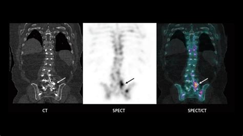 SPECT/CT imaging in the evaluation of pain following spinal fusion ...