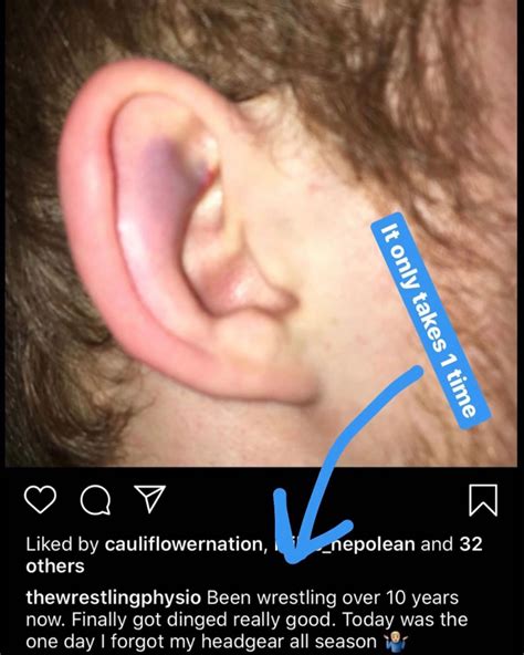 How To Prevent Cauliflower Ear - Treatbeyond2