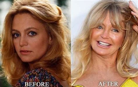 Goldie Hawn before and after plastic surgery 04 – Celebrity plastic surgery online