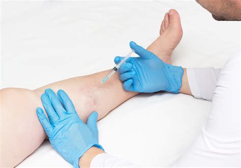 Doctor performs sclerotherapy for varicose veins on the legs, varicose vein treatment, copy ...