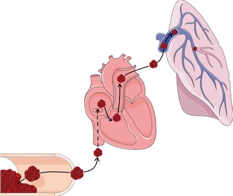 Pulmonary Embolism - PE - almostadoctor