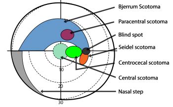 Scotoma | Types, Causes & Treatment - Lesson | Study.com