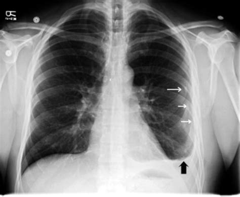 Imgs For > Flail Chest X Ray