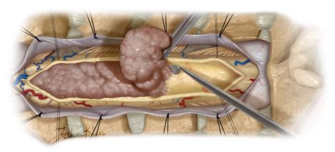 Intramedullary Spinal Cord Tumor | The Neurosurgical Atlas, by Aaron ...