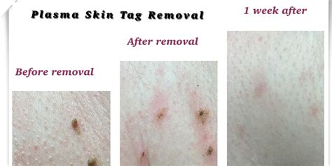 Plasma Skin Tag and Mole Removal - Eternal Beauty Lisburn