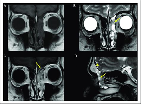 Images of inverted papilloma on MRI. A. T1-weighted coronal imaging ...