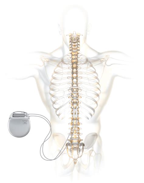 The Implant Procedure | The Spine Institute