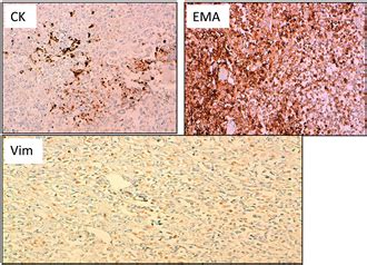 The Rhabdoid Tumor of the Kidney in Children—Cases Report