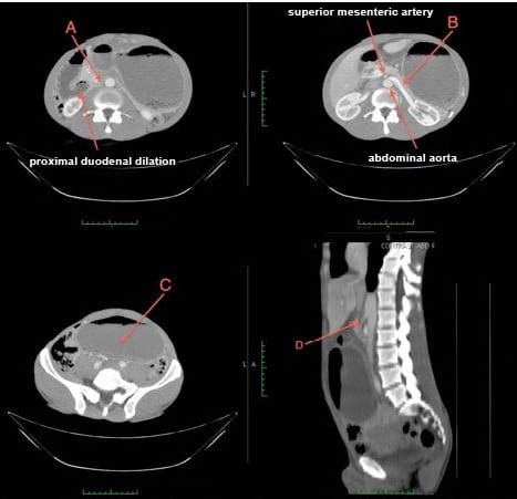 An Uncommon Case of Abdominal Pain: Superior Mesenteric Artery Syndrome - The Western Journal of ...