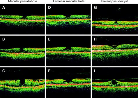 Clinical spectrum of lamellar macular defects including pseudoholes and ...