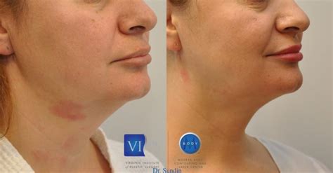 J Plasma Before & After Photos | Richmond Plastic Surgery | Med Spa