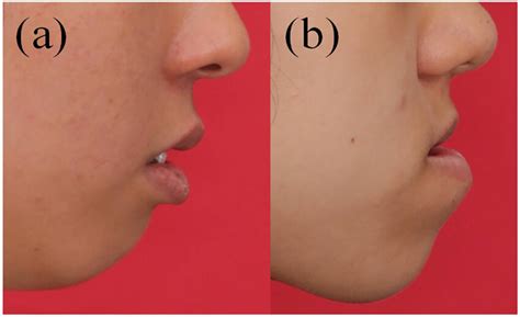 Strained lip in (a) mandibular hypoplasia, (b) mandibular hyperplasia ...