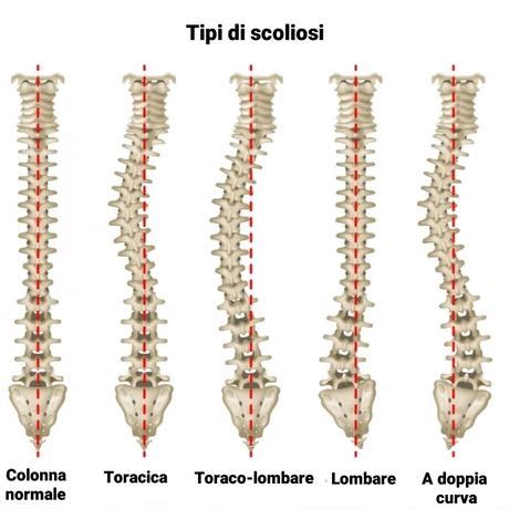 Analisi osteopatica della roto-scoliosi - Tuttosteopatia.it