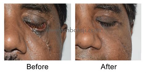 Cheekbone fracture surgery and lower eyelid correction | Cheekbone Fracture Surgery in India