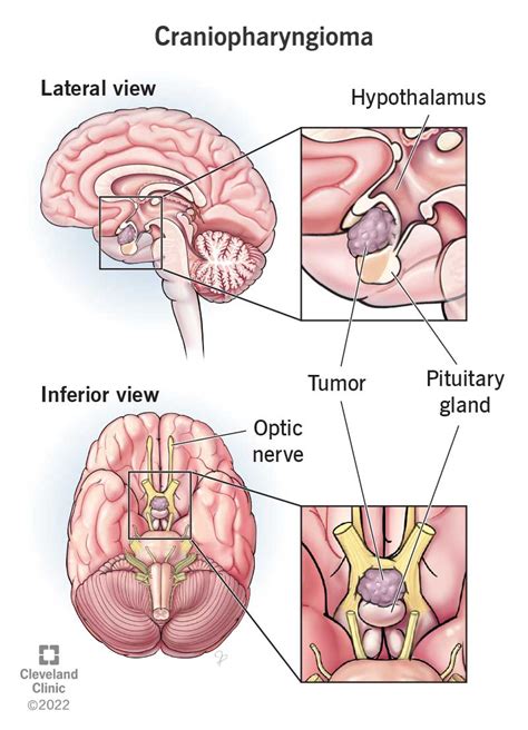 Craniopharyngioma: Definition, Symptoms, Causes & Treatment