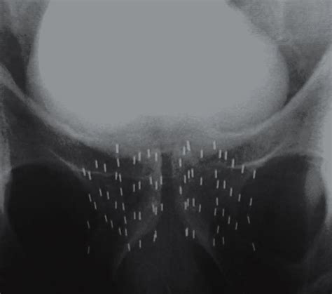 Recent Study Favors Brachytherapy in Treating Prostate Cancer - BXTA