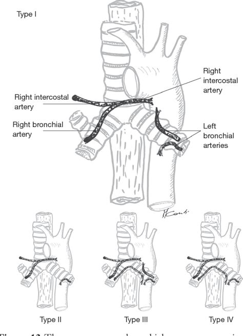 Bronchial Artery Anatomy