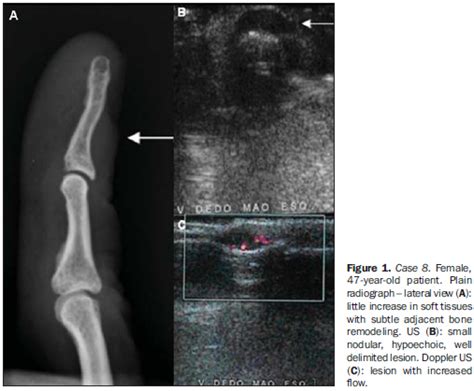 Glomus Tumor Mri