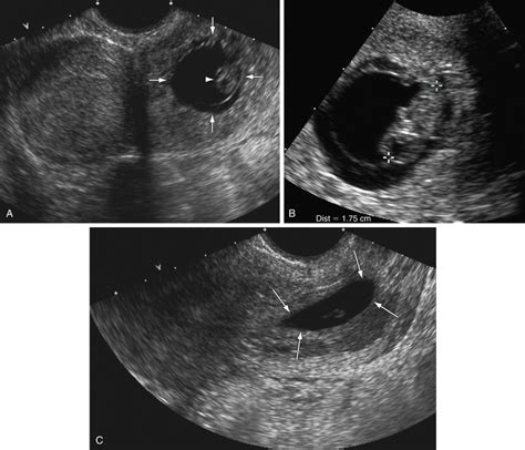 Ultrasound-Guided Treatment of Ectopic Pregnancy | Radiology Key