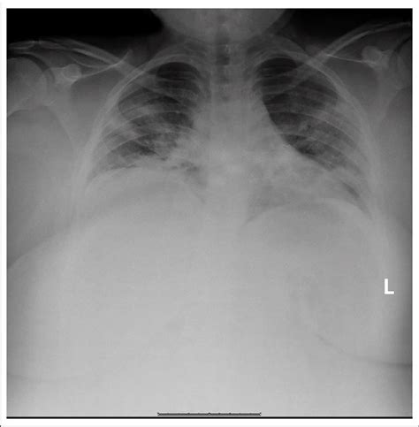 AP chest X-ray, 19-year-old female, bilateral patchy infiltrates. | Download Scientific Diagram