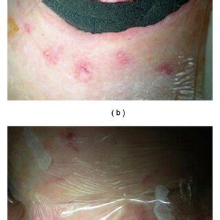 Vacuum-assisted closure therapy. | Download Scientific Diagram