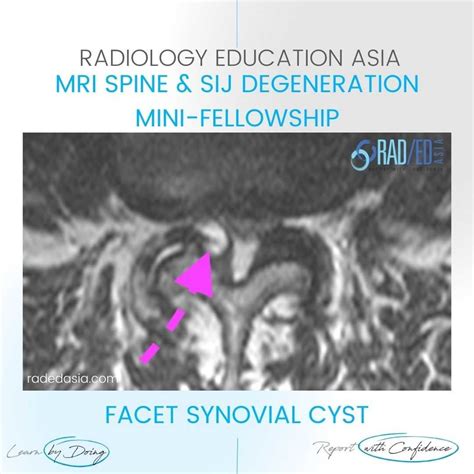 FACET SYNOVIAL CYST RADIOLOGY MRI LUMBAR SPINE - Radedasia