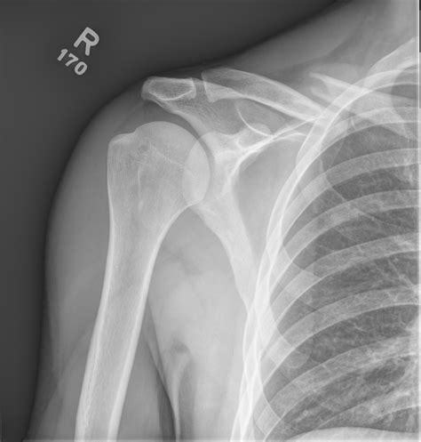 Clavicle Fractures – Core EM