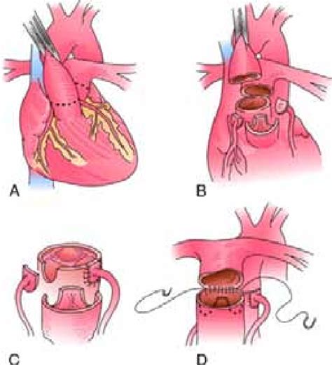 schematic view of AsO intervention. A. great artery configuration in... | Download Scientific ...