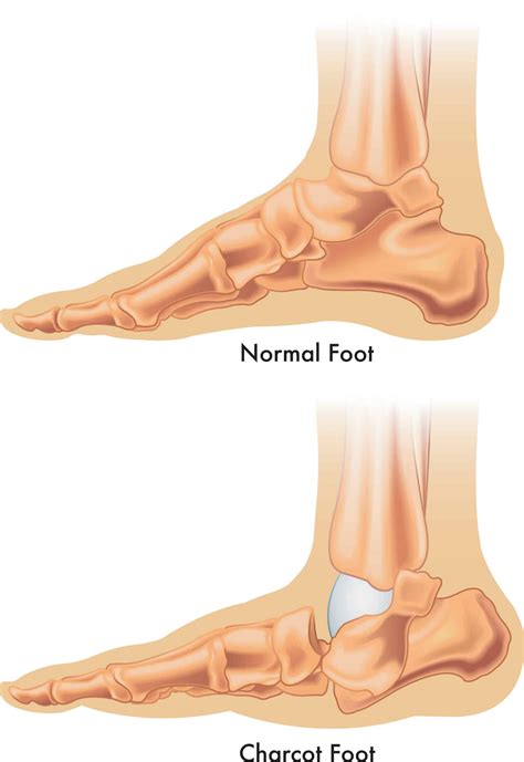 Charcot (Rocker-Bottom) Foot - Orthopedic Solutions OKC