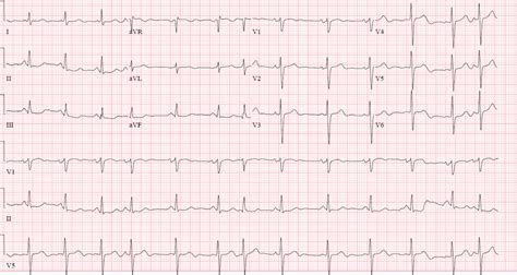 60-Year-Old Man With Skipped Heartbeat, Shortness of Breath and Light-headedness