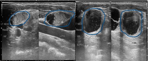 Thyroid Ultrasound: 4 Things You Need to Know