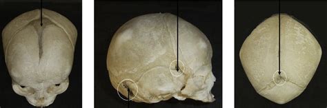 Fetal Skull/Adult Sutures Diagram | Quizlet