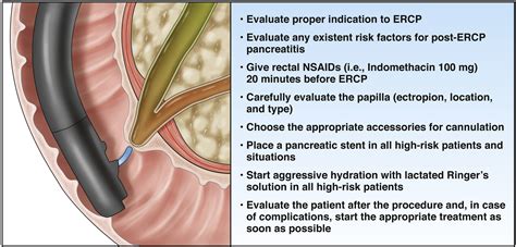 How to Prevent Post-Endoscopic Retrograde Cholangiopancreatography ...