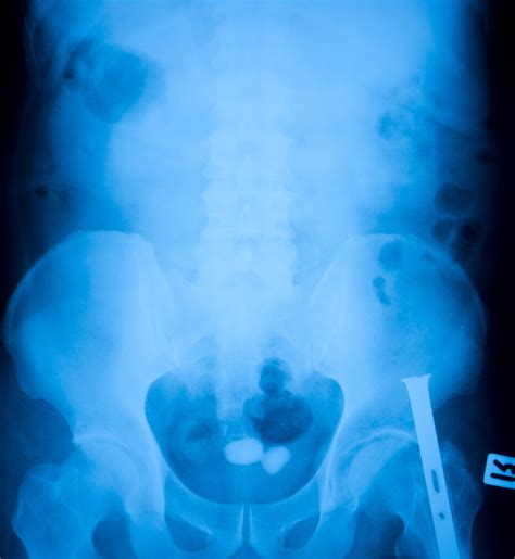 Bladder Stones - Bladder Stone Causes - Urology Austin