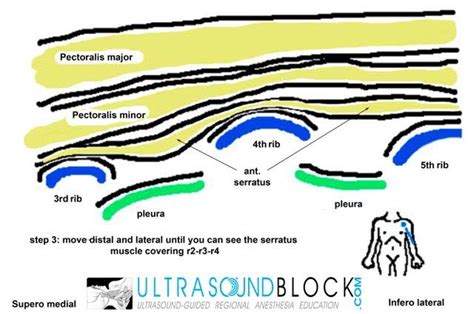 Ultrasound: Thoracic wall (PECS) blocks