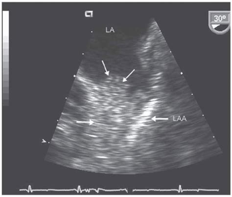 Transthoracic Echocardiography (TTE) and Transesophageal ...