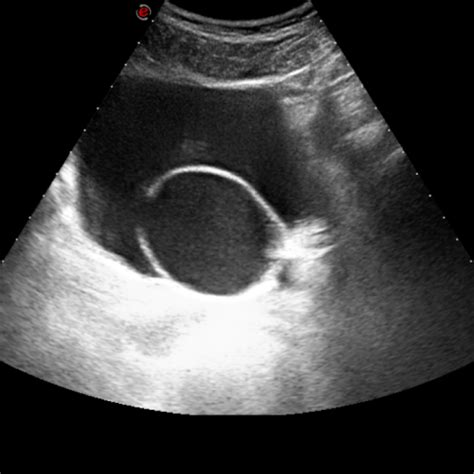 Ureterocele in adult man | Eurorad