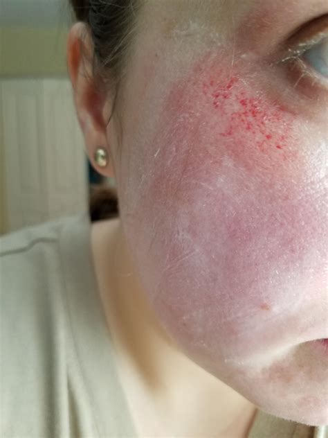 [Skin Concerns] Rug burn on face, how best to treat it? : r ...