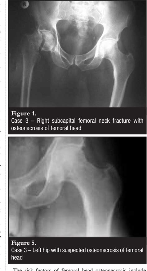 Subcapital Femoral Neck Fracture