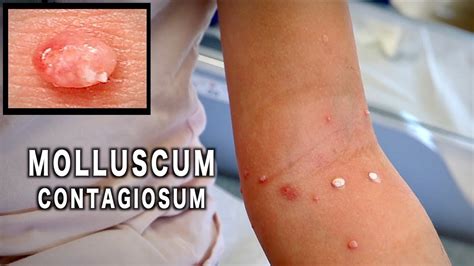 Molluscum Contagiosum Symptoms, Causes, And Treatments, 56% OFF