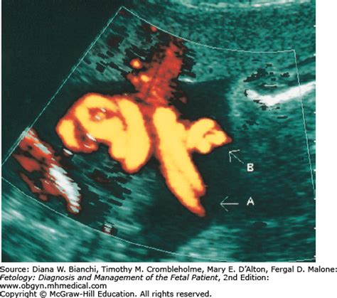 Monoamniotic Twins | Obgyn Key