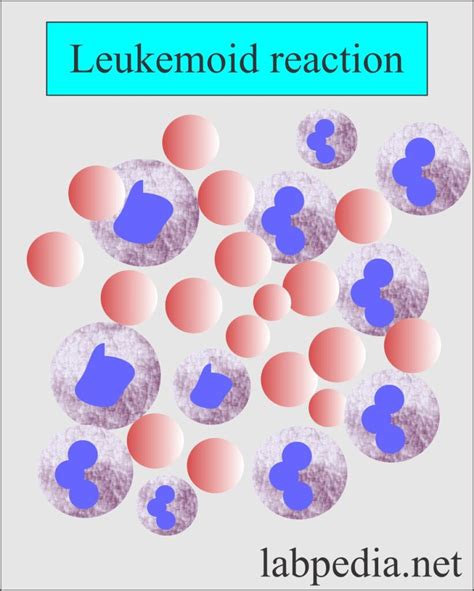 Leukemoid Reaction and Diagnosis (D/D from Chronic Myelocytic leukemia) - Labpedia.net