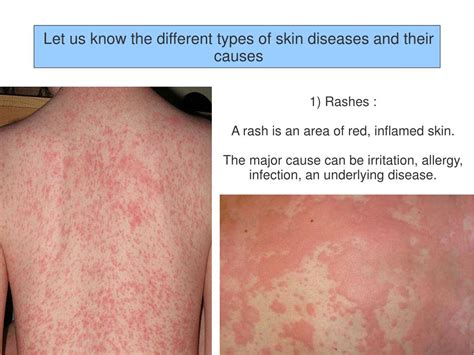 PPT - Different Types Of Skin Diseases And Their Causes PowerPoint Presentation - ID:7173361