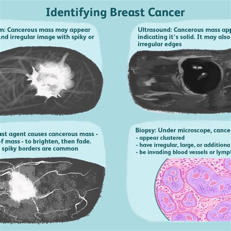 Breast Masses Cancerous Tumor Or Benign Lump