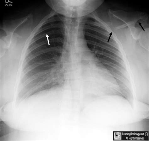 Cleidocranial dysplasia; Cleidocranial Dysostosis; Dysostosis ...